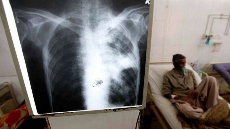 Tuberculosis: preocupación por el 38% de aumento de casos en lo que va del 2025