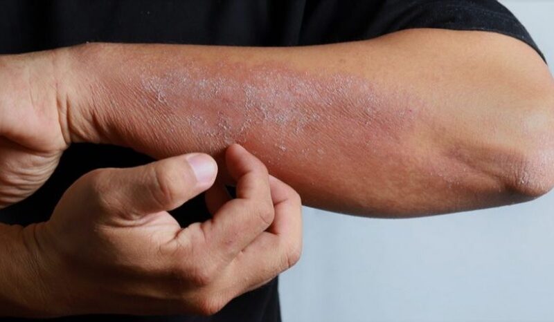 Campaña de detección gratuita de dermatitis atópica: brindan turnos para el Hospital de Quilmes