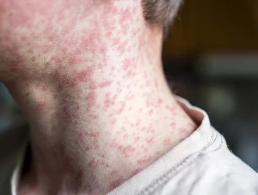 Provincia lanzó un nuevo alerta por sarampión